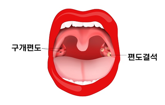 편도와 편도결석