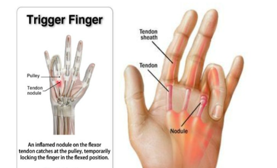 방아쇠 손가락 관련 이미지
