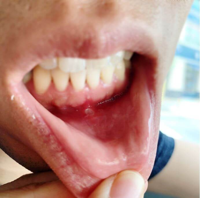 입안에 구내염이 생긴 모습