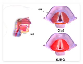  후두염 증상