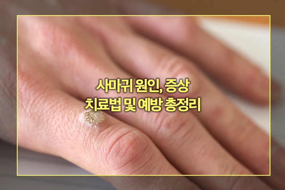 사마귀 원인, 증상, 치료법