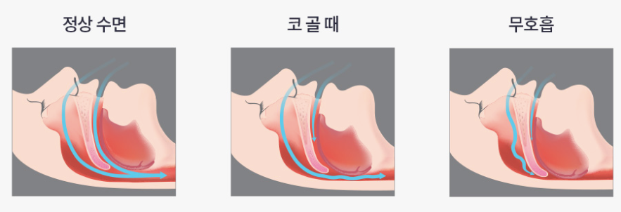 정상 수면, 코골이, 수면무호흡증 비교