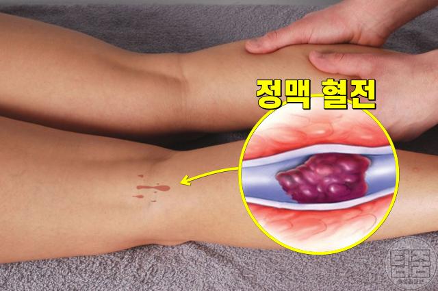 무릎 뒤 통증 원인 혈전