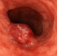 헬리코박터균 원인