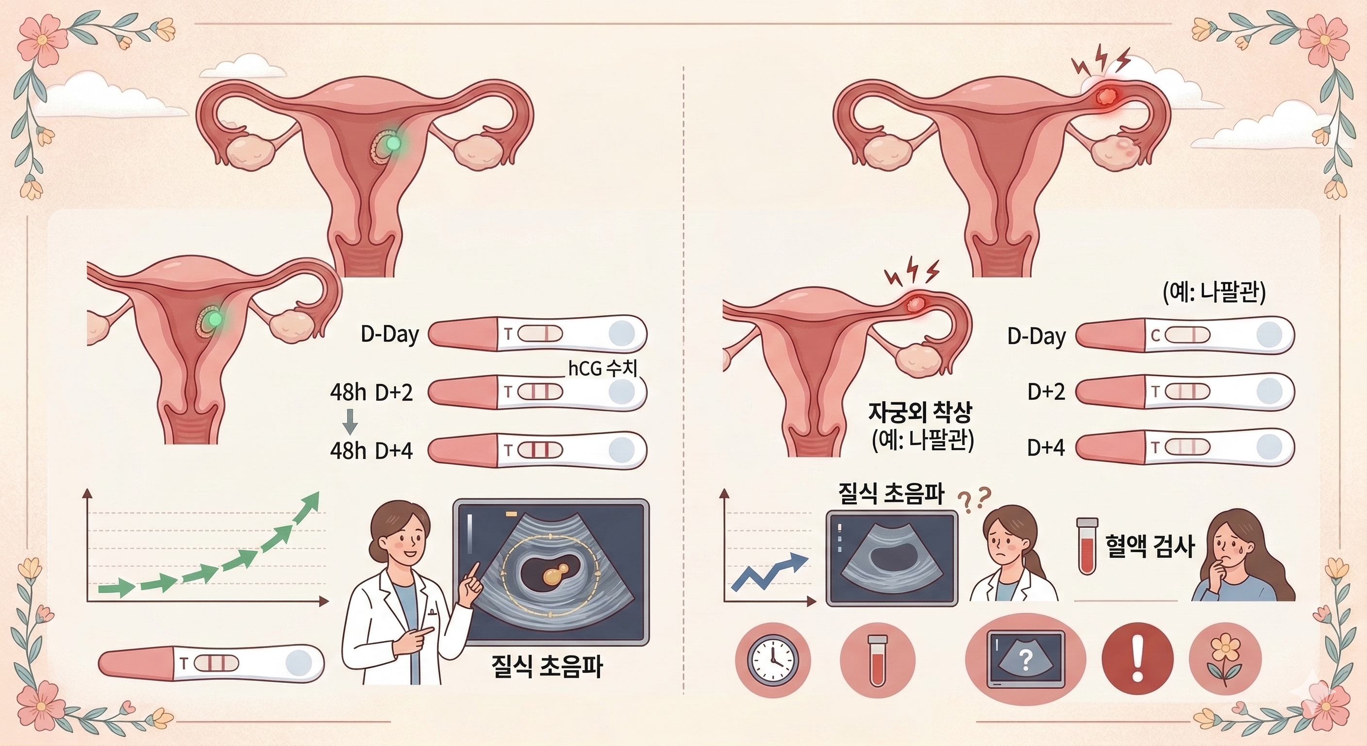 자궁외 임신