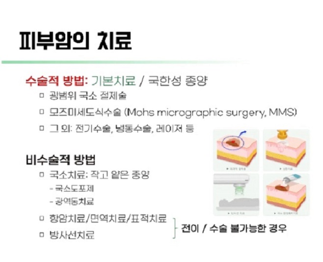 피부암치료