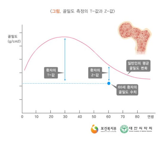 Bone Densitometry,-T score-Z-score