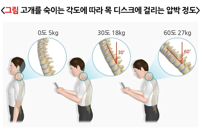 일자목-거북목-각도
