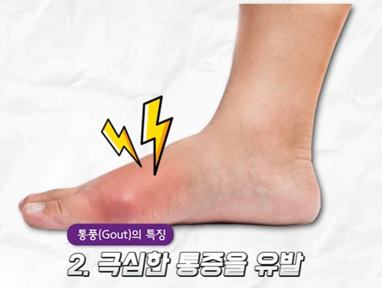 통풍2