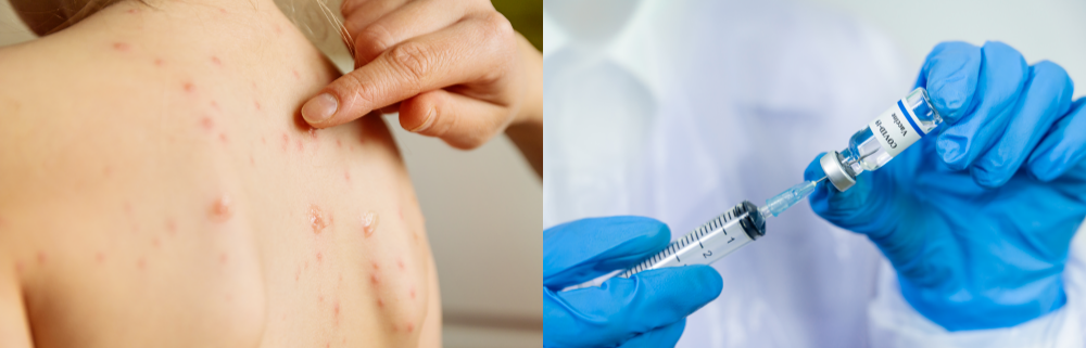 WHO경고! 홍역 재유행 관련 이미지