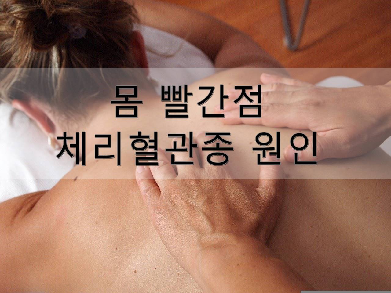 체리 혈관종