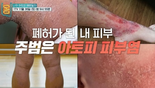 나의아토피해방일지