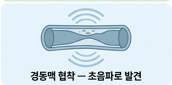 경동맥 협착을 발견하는 경동맥 초음파
