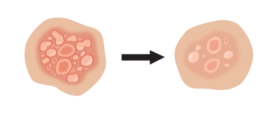 헤르페스 2형 증상