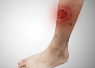 척추관협착증 증상 19