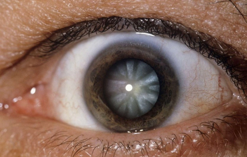 노안 백내장 수술 종류 비용 총정리