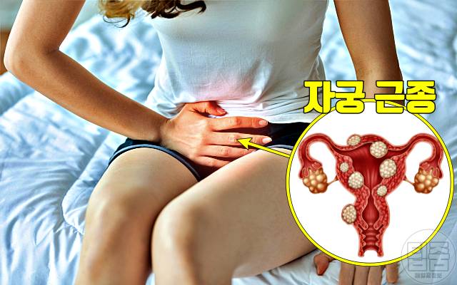 암 초기증상,자궁 근종 증상