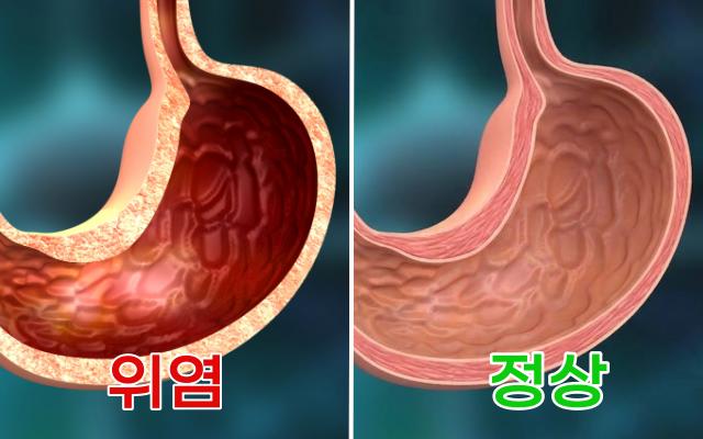속이 쓰린 이유 속쓰림 원인 위염