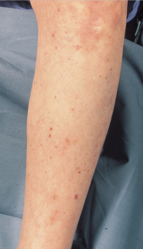 수막구균 혈류 감염으로 인한 발진