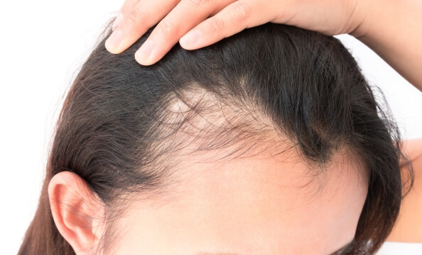 탈모샴푸의 특징과 추천 제품