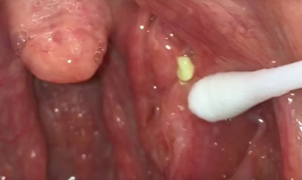 편도결석-면봉으로빼기