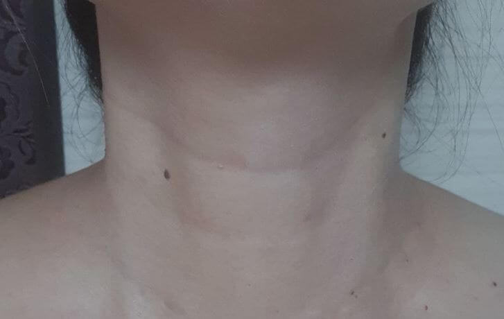 쥐젖 제거 후 모습