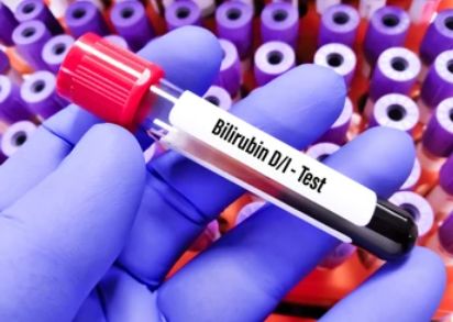 총빌리루빈 수치