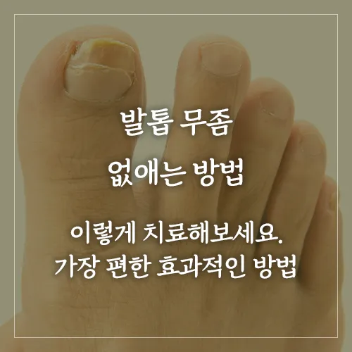 발톱-무좀-없애는법