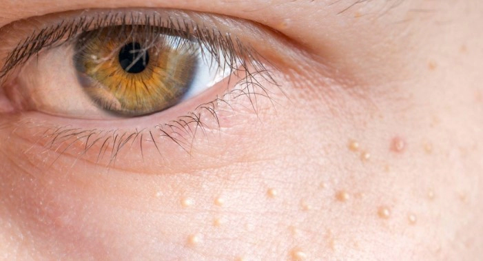 비립종 원인 생기는 이유 5가지