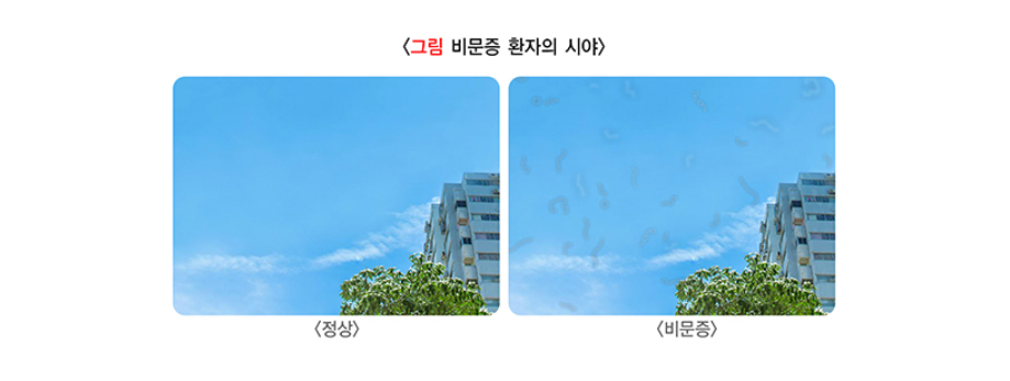 비문증 환자의 시야