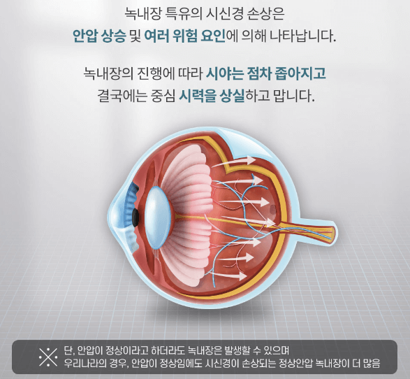안압증가