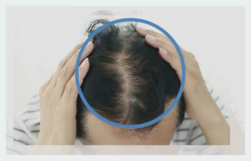 남성 중앙 탈모