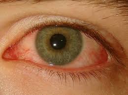 눈 실핏줄이 터지는 이유