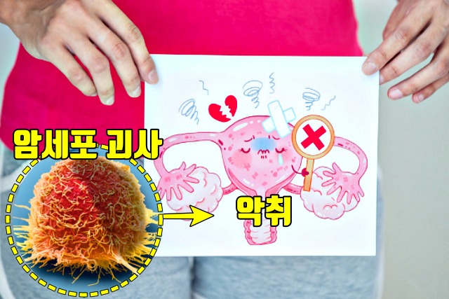 질분비물 자궁암 증상 원인, 자궁경부암, 자궁경부암초기증상, 건강 팁줌 매일꿀정보