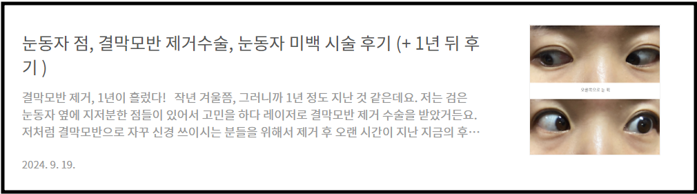 결막모반 시술후기