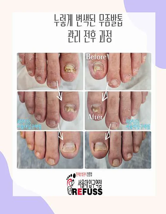 레푸스 발각질 내성발톱 무좀발톱 관리