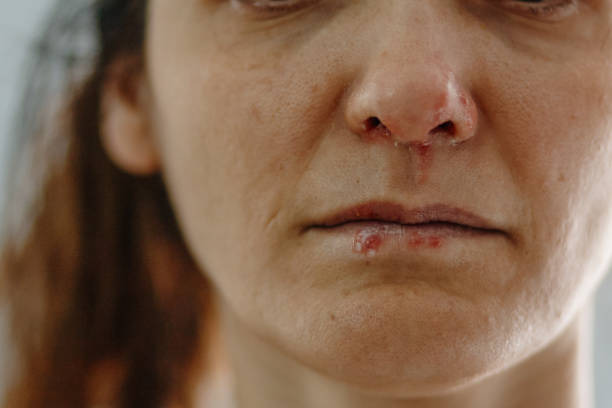 입술포진 빨리 낫는 법과 재발 방지법