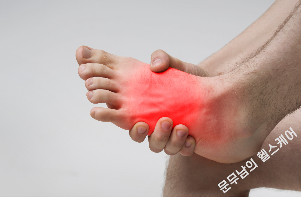 발등 인대 늘어났을 때