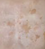 고지혈증 증상 9