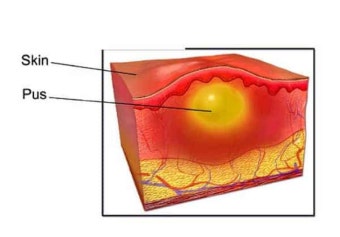 화농성 한선염 치료 수술 병원