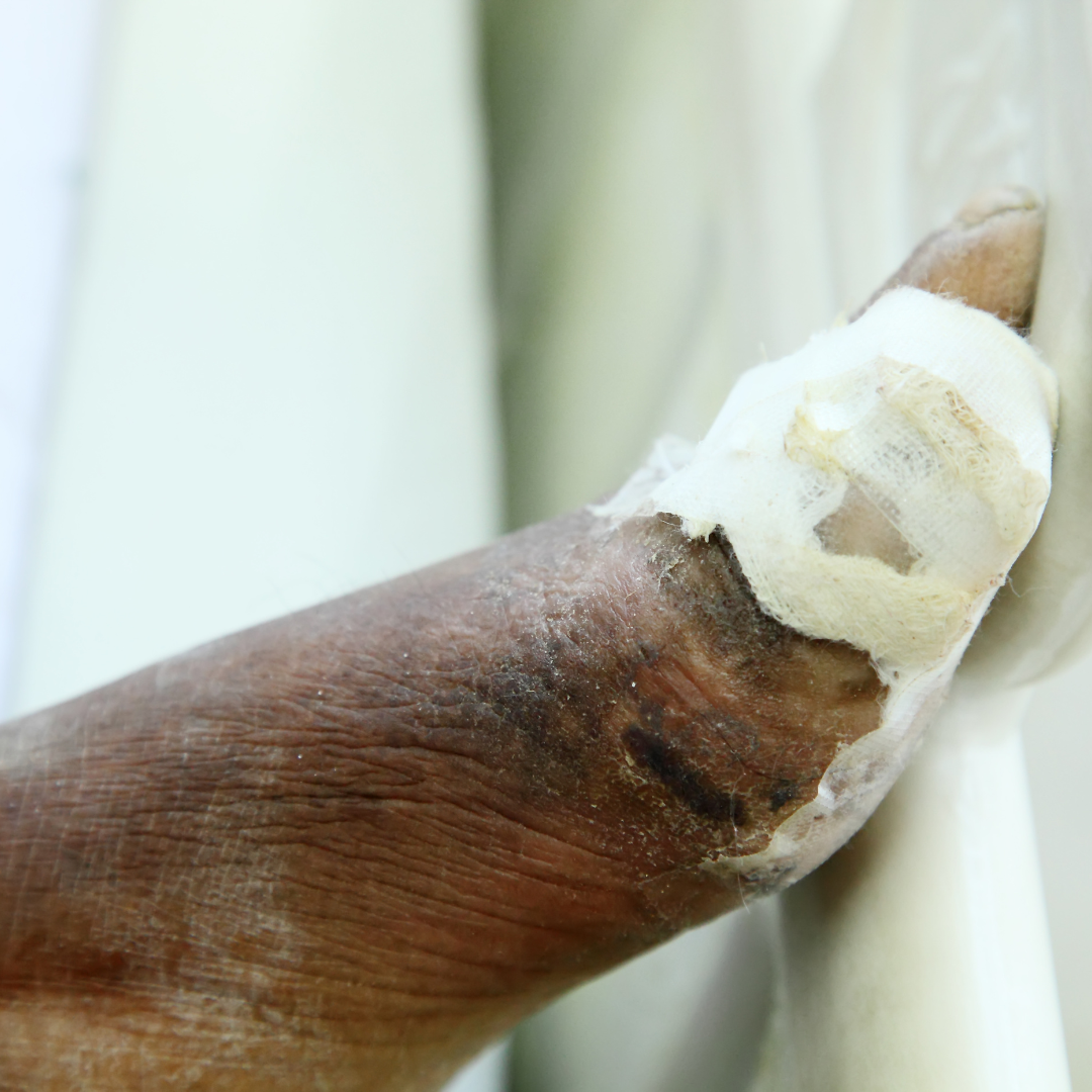 욕창 예방 치료 증상 원인