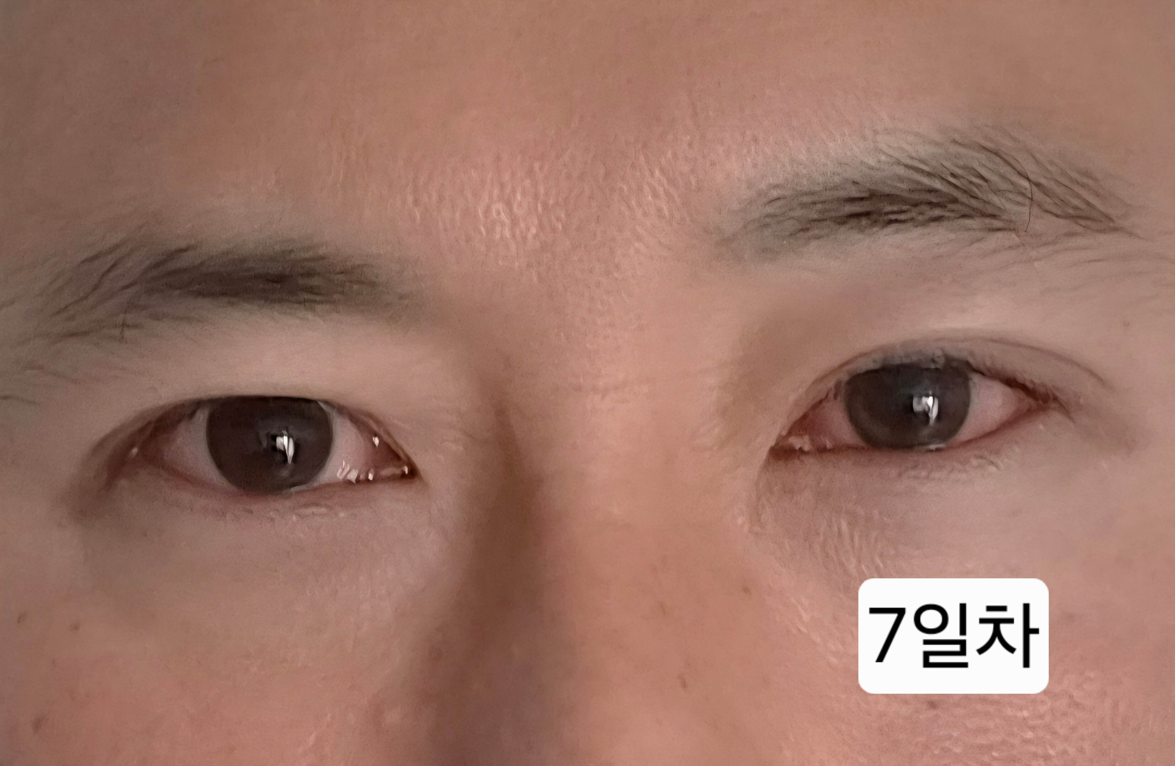 유행성각결막염 눈병 초기증상부터 12일차 치료 기록(진행 중)