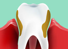 잇몸이 붓고 아플 때