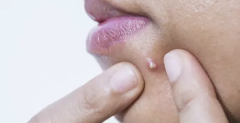 입술에 물집이 생기는 이유 16