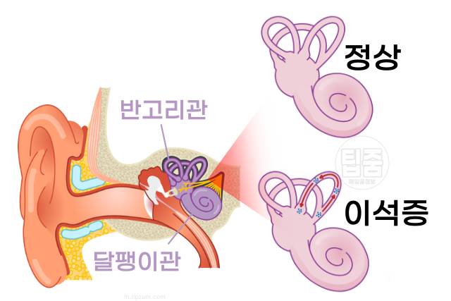 어지럼증 원인 귓병 어지러움 원인 이석증