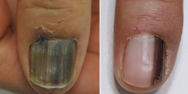 손발톱밑 흑색종 치료방법
