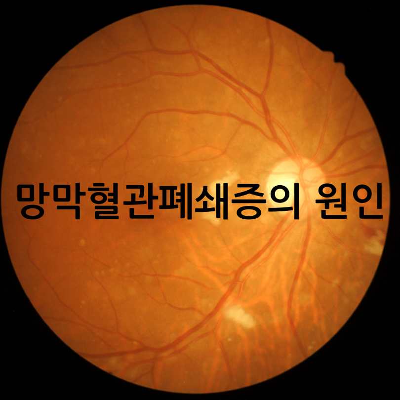 망막혈관폐쇄증(눈중풍)