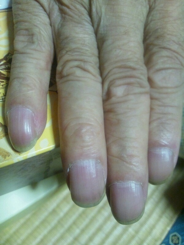 손가락이 ‘이 모양’ 이라면… 당장 병원부터 가세요.