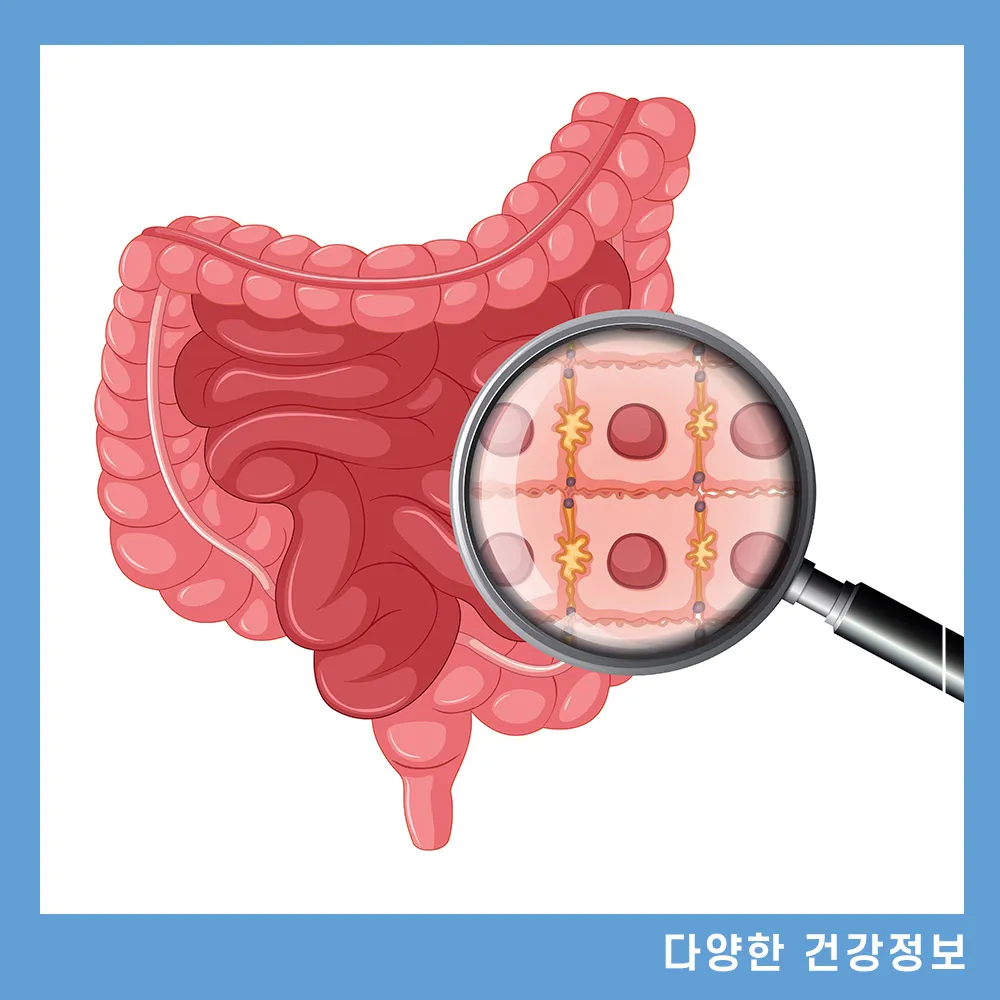직장암-증상-치질-생존율