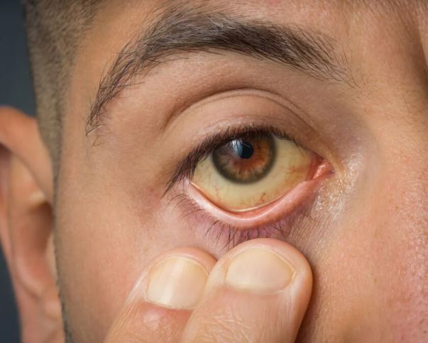 빌리루빈-정상수치